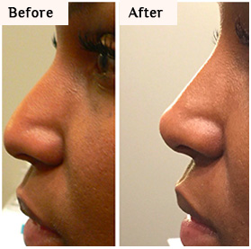 before and after nose reshape